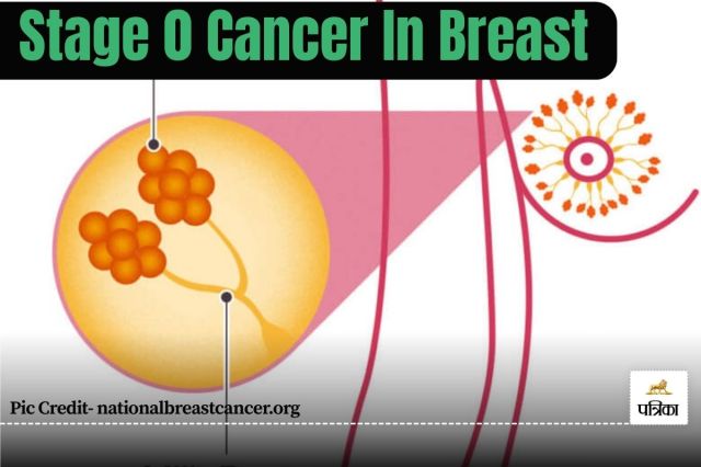 stage 0 cancer photo