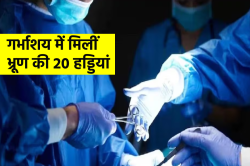 पेट दर्द से परेशान थी महिला… गर्भाशय से निकले हड्डी के 20 टुकड़े, डॉक्टर हैरान - image