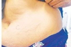 Myhealth:पानी की हर बूंद बन रही सजा, महिला में दुर्लभ बीमारी एक्वाजेनिक
अर्टिकारिया के लक्षण - image