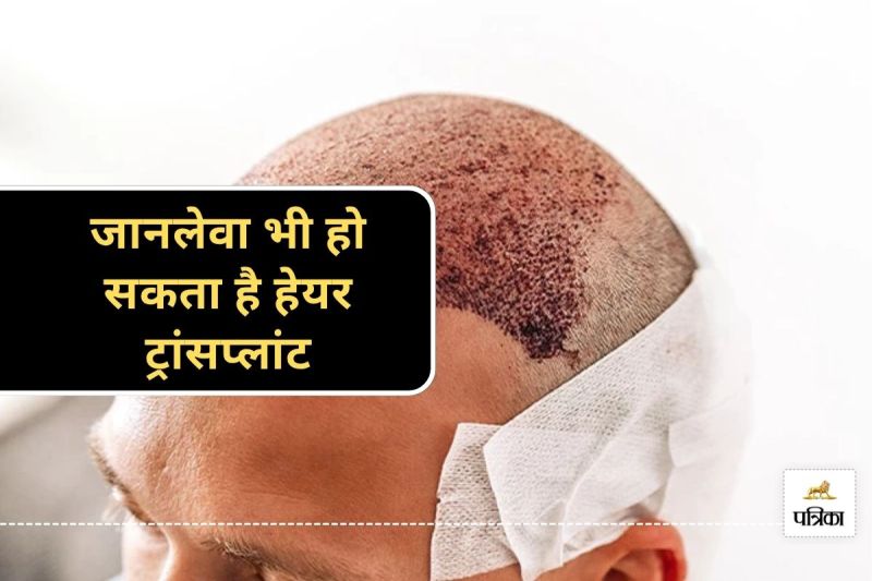 Hair Transplant Side Effects