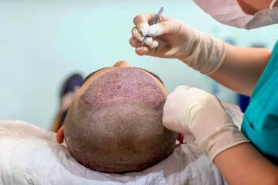 Hair Transplant