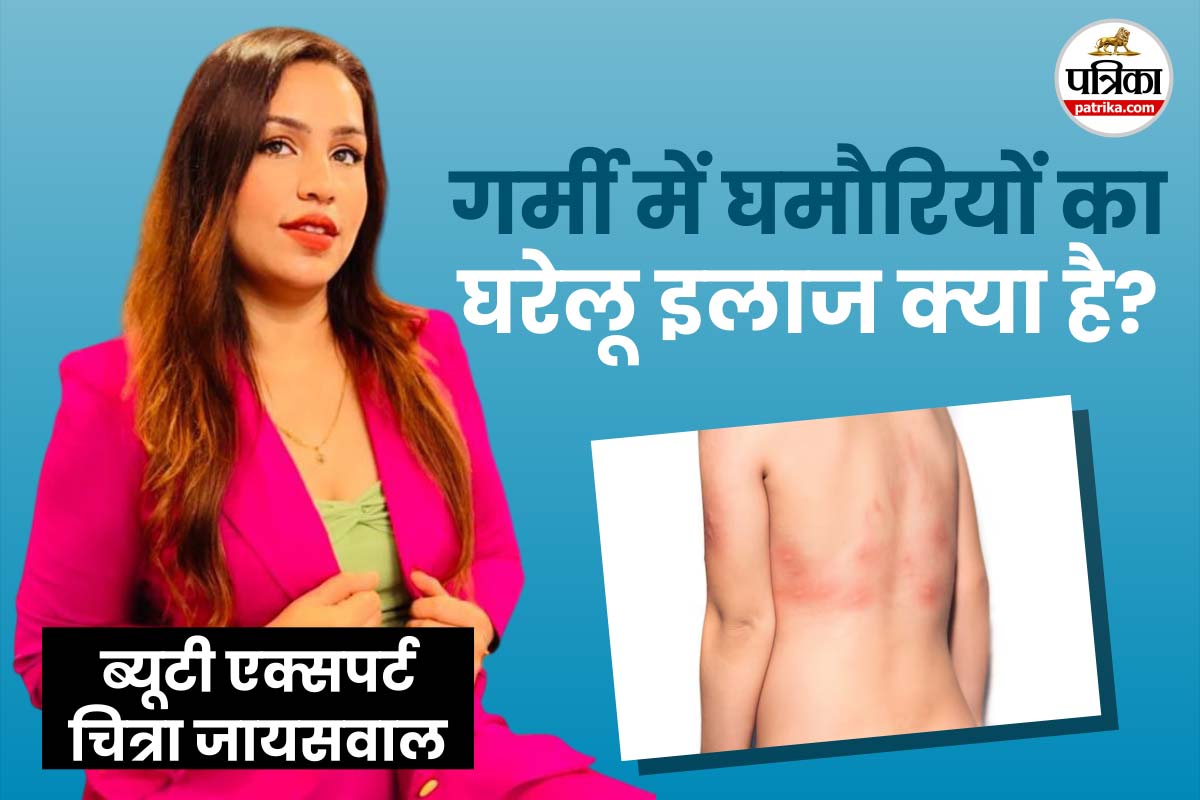 Natural remedies for ghamoriya फोटो सोर्स - Freepik
