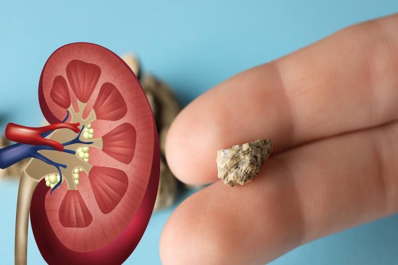 CG News: कम उम्र के बच्चो से लेकर बुजुर्ग तक पथरी की गिरफ्त में, शराब बनी बड़ी वजह