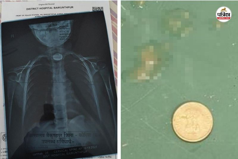 Child swallowed coin
