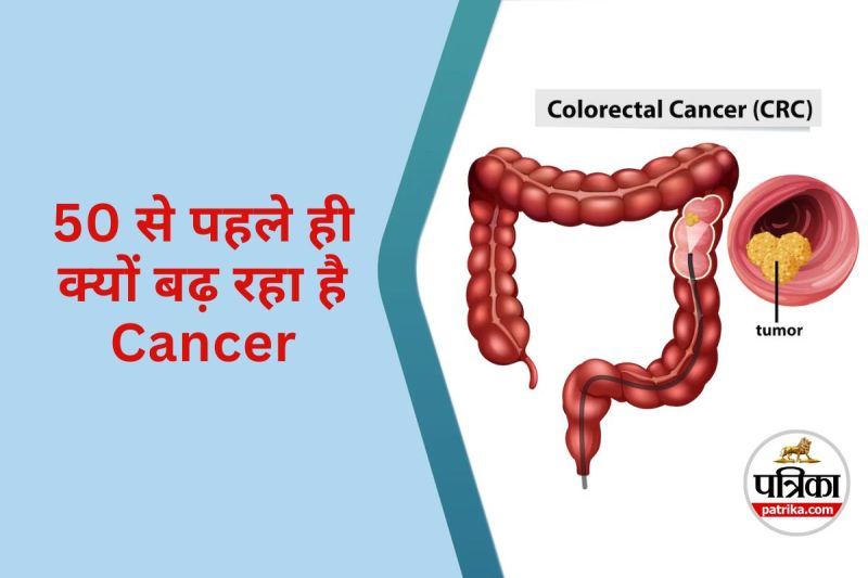 Why Colorectal Cancer is Striking Before 50