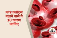 Causes of Blood Clots