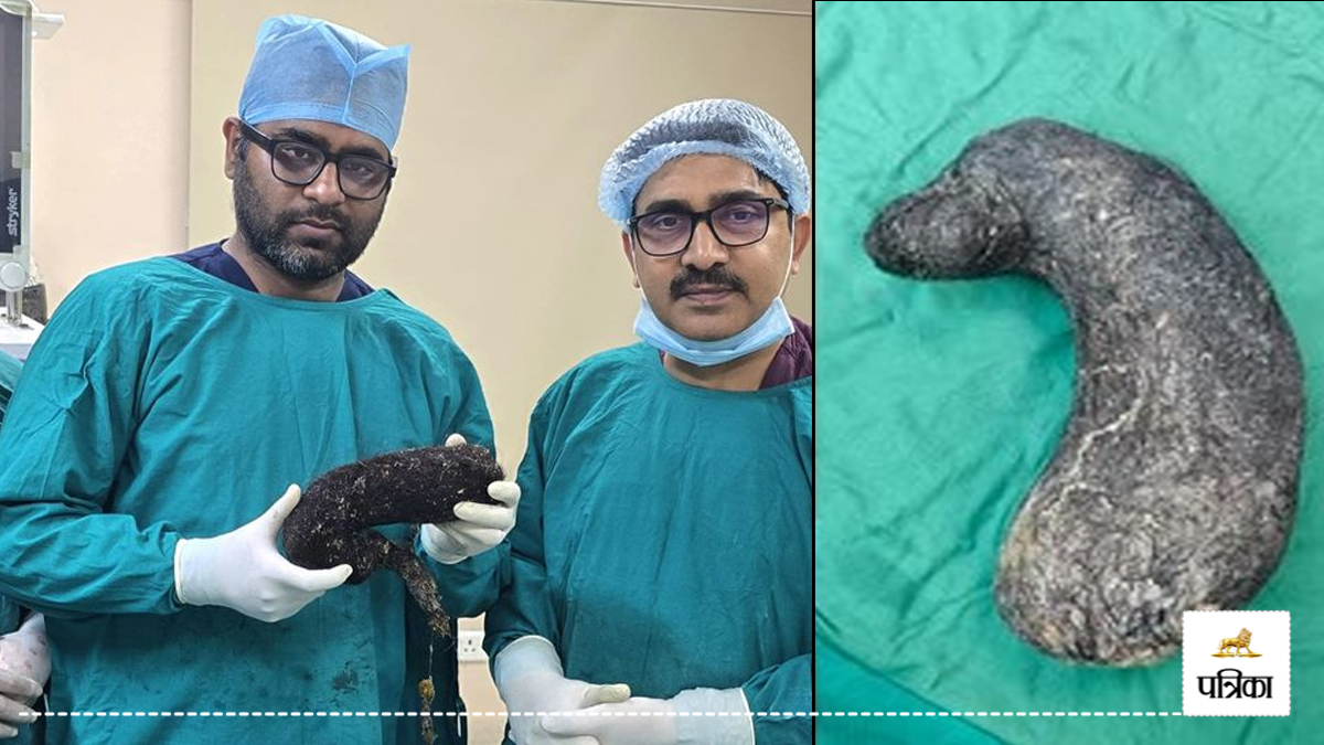 Half kilo of hair was found in stomach of girl in Prayagraj