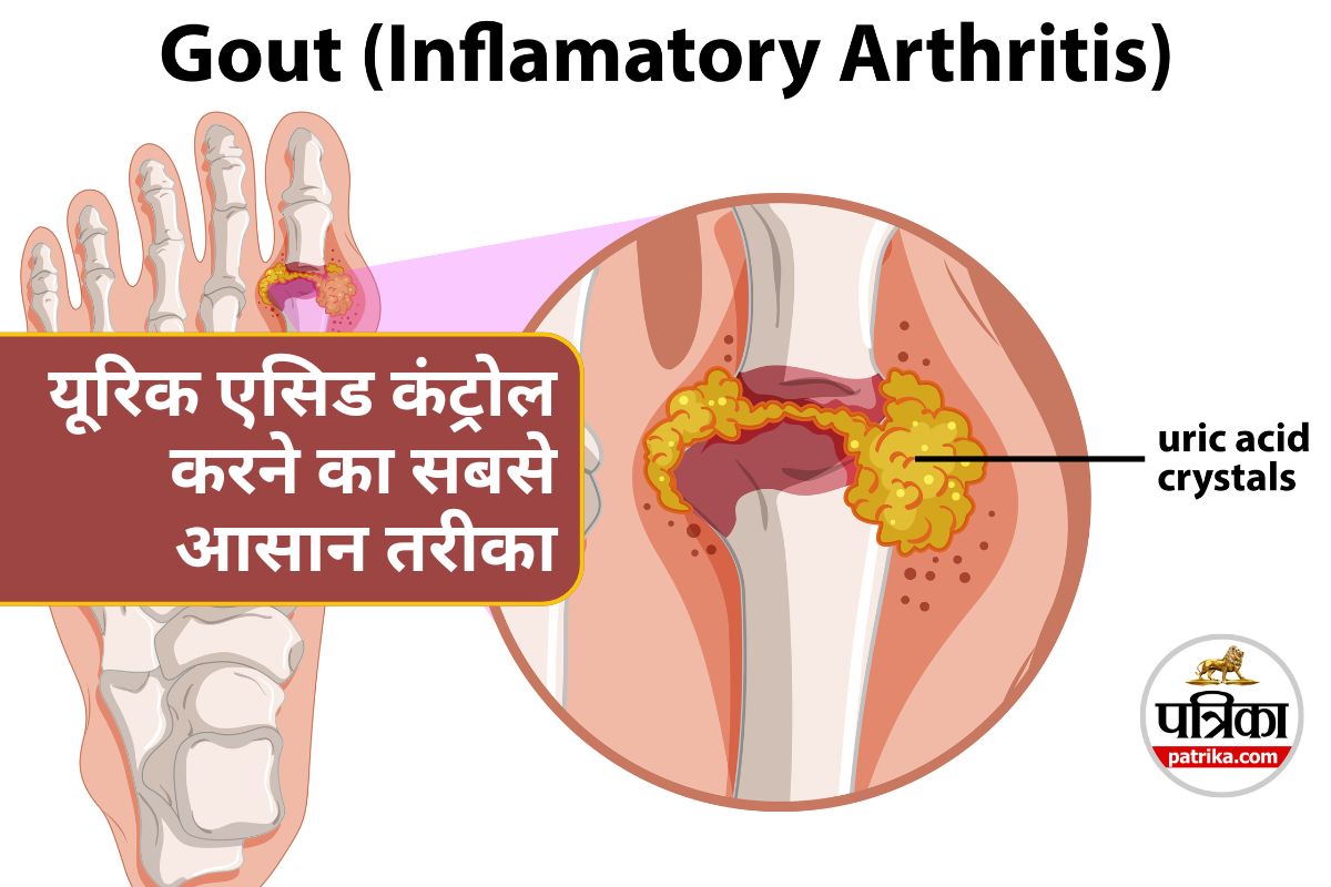 High Uric Acid : जानिए कैसे पानी यूरिक एसिड को कंट्रोल करने में मदद कर सकता है