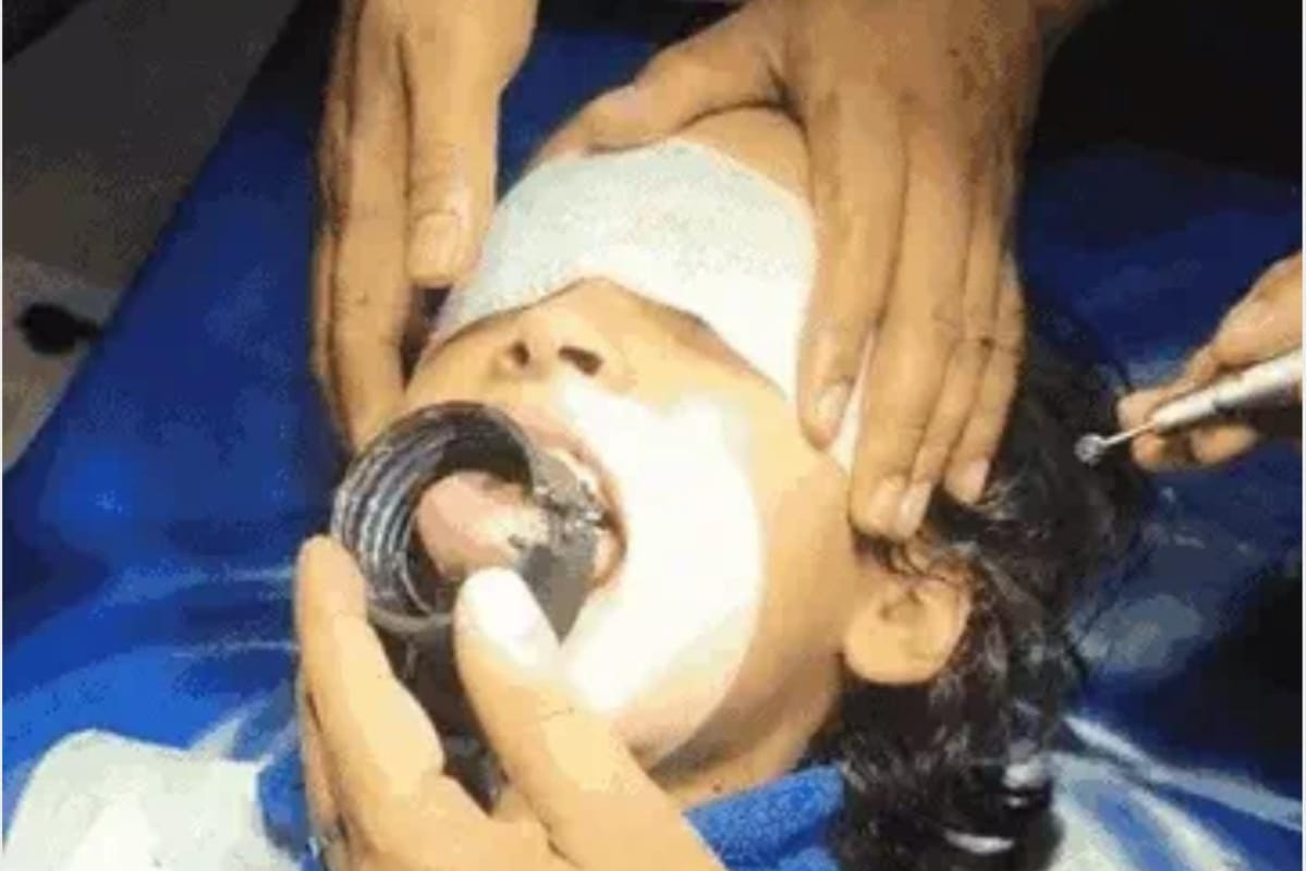 पानी पीते समय बोतल के ढक्कन में फंसी मासूम की जीभ, ढाई घंटे तक अटकी रही परिजनों
की सांस