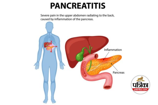 Pancreatic Cancer