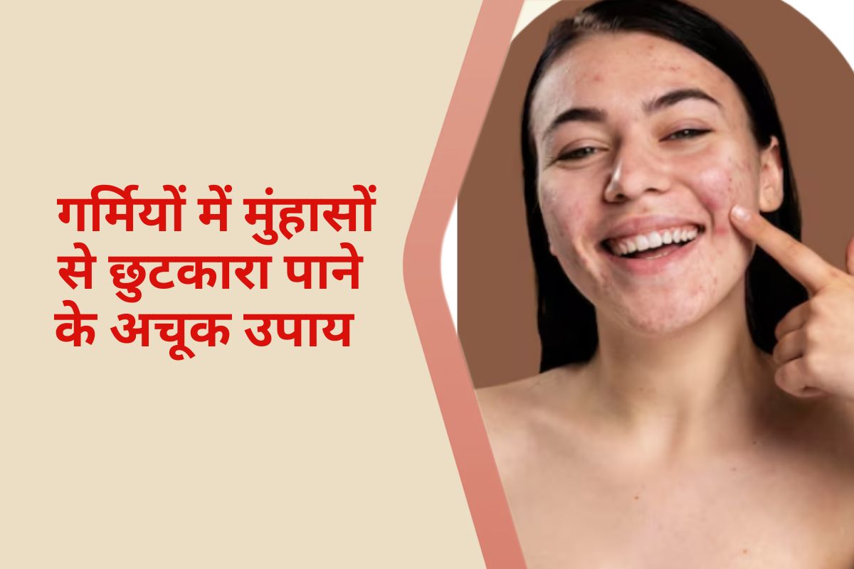 Prevent Acne in Summer : गर्मियों में मुंहासों से बचने के उपाय