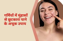 Prevent Acne in Summer : गर्मियों में मुंहासों से बचने के उपाय - image