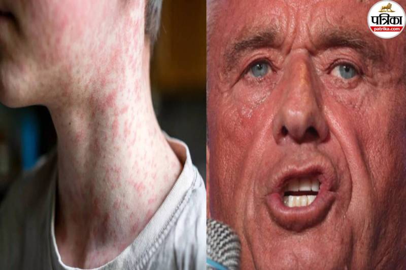 US measles outbreak 2025