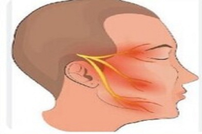 CG News: ट्राइजेमिनल न्यूराल्जिया बीमारी से चेहरे पर बिजली के झटके जैसा अहसास, युवा भी हो रहे शिकार, जानें बचने के उपाय