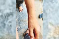 hand-foot-mouth disease