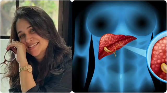 Dipika kakar Liver Cancer