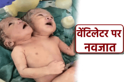 दो सिर वाली बच्ची में ‘हार्ट डिफेक्ट’, हालत नाजुक, वेंटिलेटर पर नवजात - image