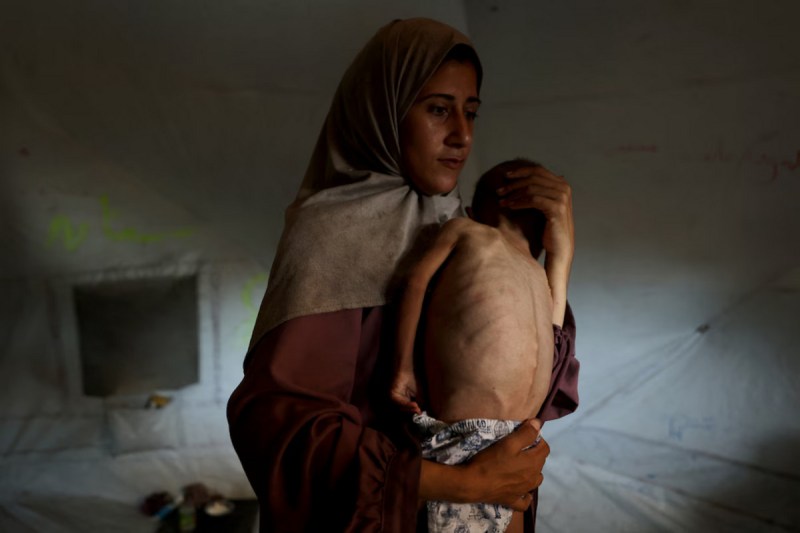 Malnutrition in Gaza