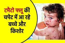 संक्रमित बच्चों के छींकने से फैल रहा वायरस, टोमैटो फ्लू का Alert, एक्सपर्ट ने
बताए लक्षण और उपाय - image
