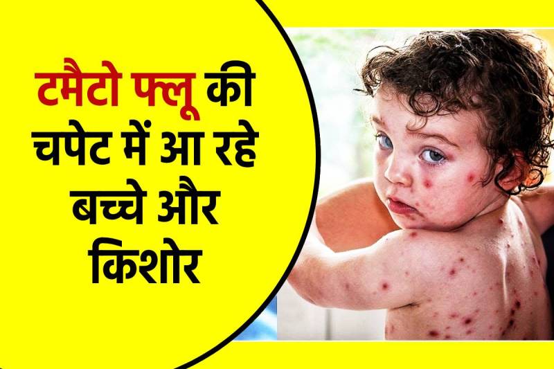 tomato Flu Attack on Children Symptoms Causes Cure health Alert