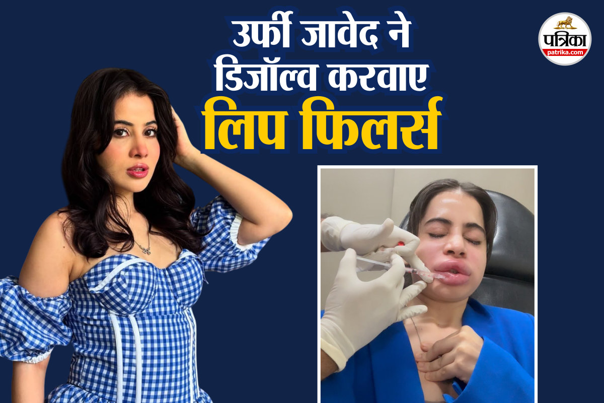 Side Effects Of Lip Fillers, Lip Fillers Dissolve, Urfi news, lifestyle news,