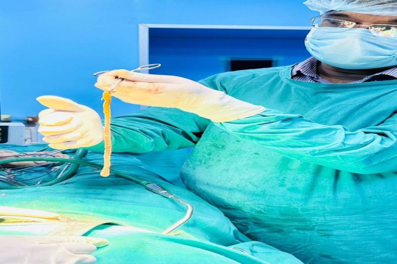 दुर्लभ सर्जरी कर २२ सेमी अपेंडिक्स को निकाला बाहर, बची मरीज की जान 22 cm appendix removed in rare surgery, patient's life saved