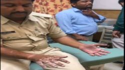 तेजाब से झुलसकर भी कांस्टेबल ने बचाई युवक की जान - image