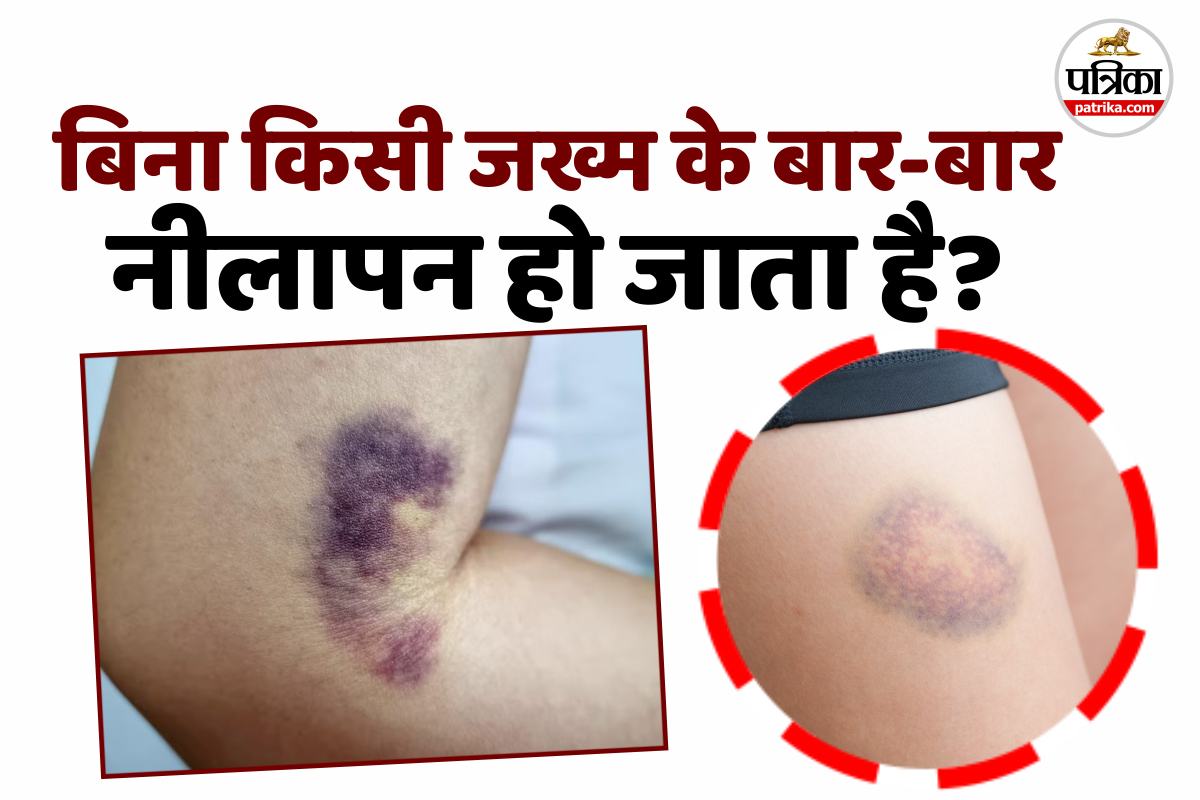 Bina chot lage neel padna, health warning, How to heal a bruise,What are bruises caused, health news,