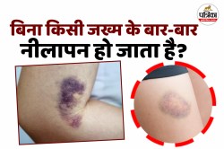 Vitamin Deficiency: बिना चोट के नील पड़ते हैं? जानिए शरीर में किन विटामिन्स की
कमी हो सकती - image