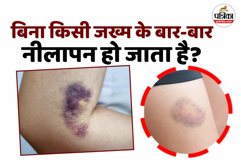Bina chot lage neel padna, health warning, How to heal a bruise,What are bruises caused, health news,