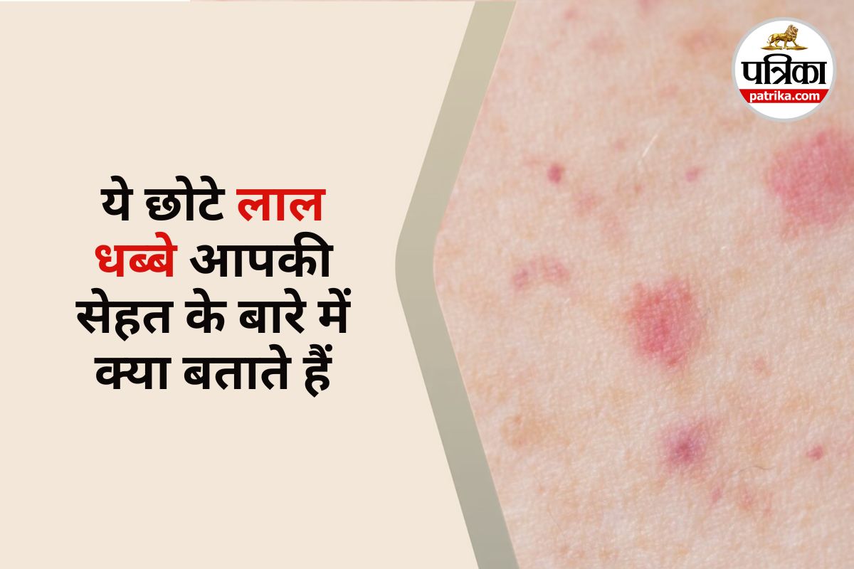 Cherry Angiomas, Red spots on skin, Cherry angioma causes