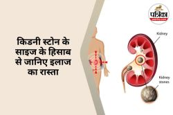 Kidney Stone : कौन-सा किडनी स्टोन खुद निकल सकता और कब जरूरी है सर्जरी? - image