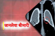 Lung