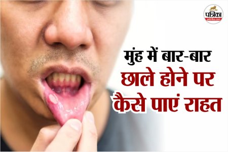 Mouth ulcer treatment, Mouth ulcer , छाले होने के कारण,
