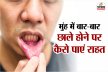 Mouth Ulcers: क्या आपके मुंह में बार-बार छाले होते हैं? इन उपायों से पाएं राहत