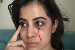 उर्फी जावेद हुईं लहूलुहान, चेहरे से बहता दिखा खून - image