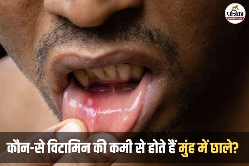 Vitamin Deficiency,Mouth Ulcers,Which Vitamin Causes Mouth Ulcers,muh ke chale kaise thik,