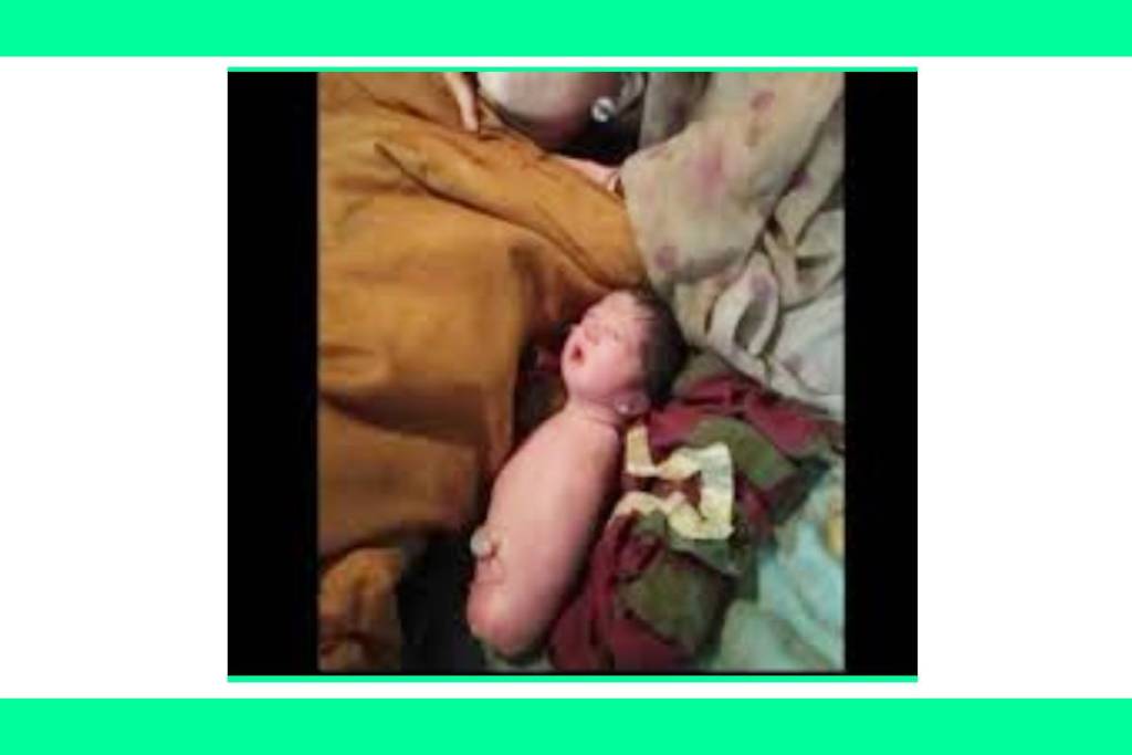 baby girl was born without hands and legs in vidisha MP rarest baby born