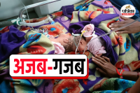 betul Twins conjoined head