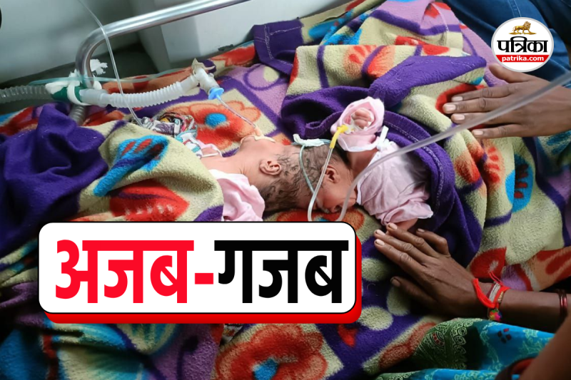 betul Twins conjoined head