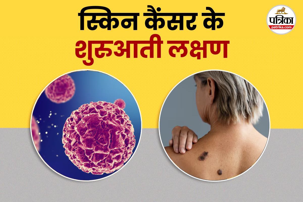 Skin Cancer: लंबे समय तक घाव का न भरना हो सकता है स्किन कैंसर का शुरुआती लक्षण,
नजरअंदाज न करें