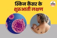 skin cancer symptoms, कैंसर का शुरुआती लक्षण, cancer , skin cancer,