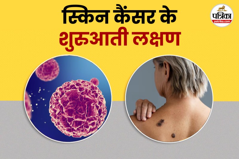 skin cancer symptoms, कैंसर का शुरुआती लक्षण, cancer , skin cancer,