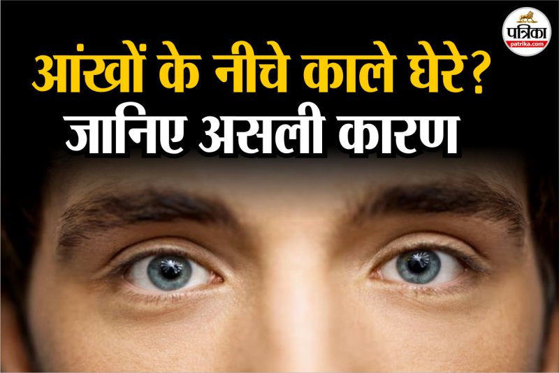 Dark Circles,Dark Circles Causes,Dark Circles Reasons,