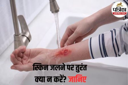 How to treat burns at home, Home Remedies, जली हुई त्वचा का इलाज,