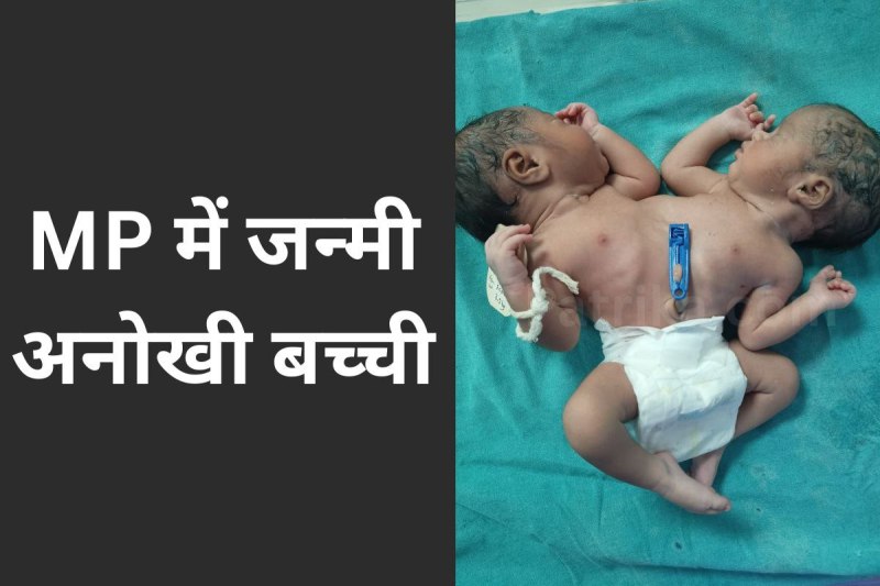 rare baby birth two heads four hands 2 hearts indore mp news