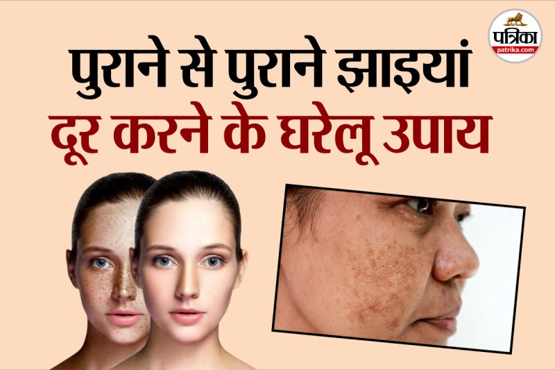 pigmentation, how to get rid of pigmentation, home remedies for pigmentation,
