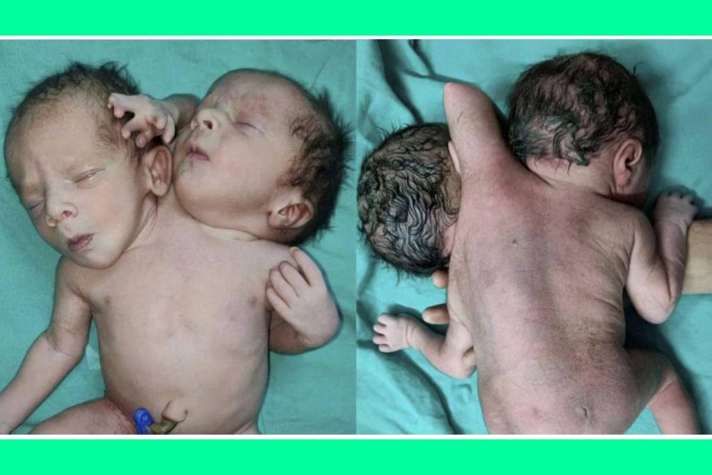 two face and three hands rarest baby was born in MP