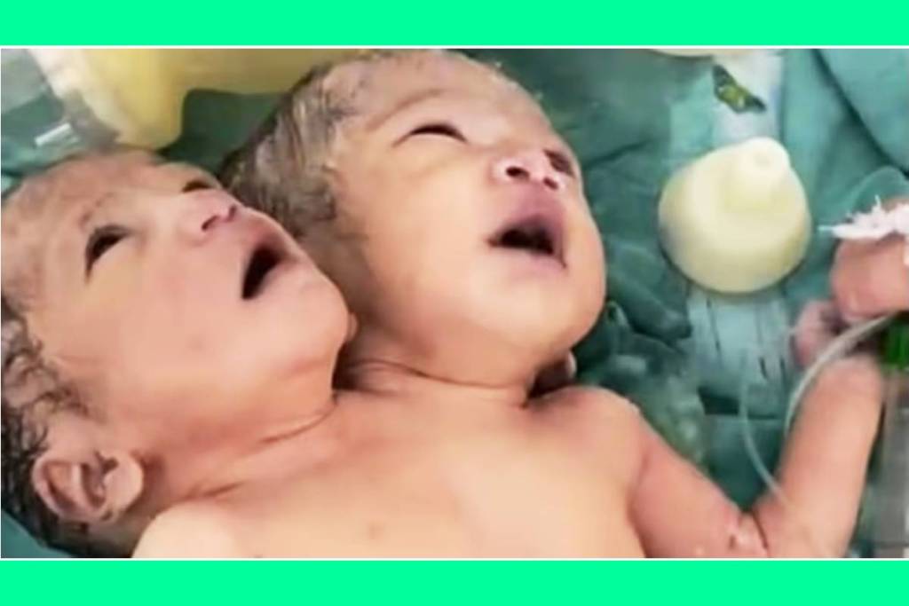 two head baby girl born in indore