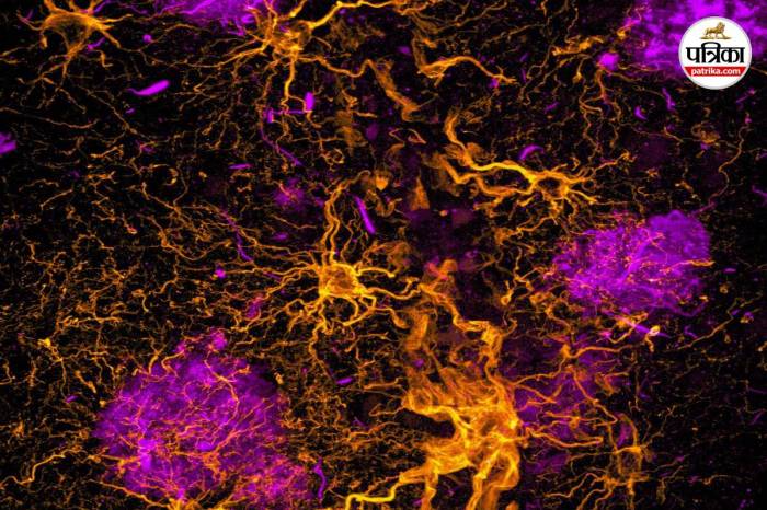 alzheimer-treatment-blood-test-drug-update-2025